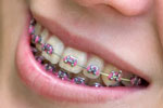 Braces custom colour