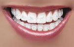 Braces tooth coloured