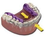 Inman Aligner